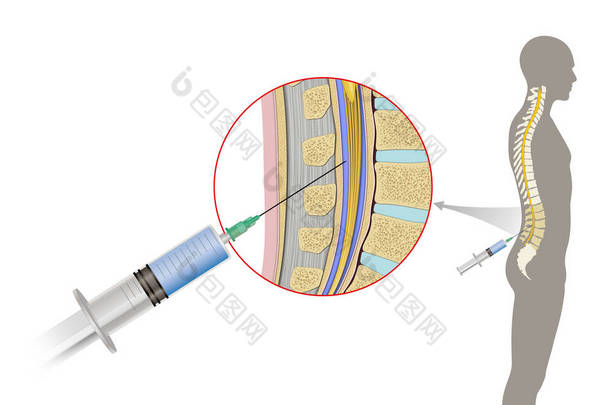 腰椎穿刺（英语：Lumbar puncture）也被称为<strong>脊</strong>柱穿刺（英语：spinal tap），是一种将针头插入<strong>脊</strong>柱管的医疗程序。脑<strong>脊</strong>液