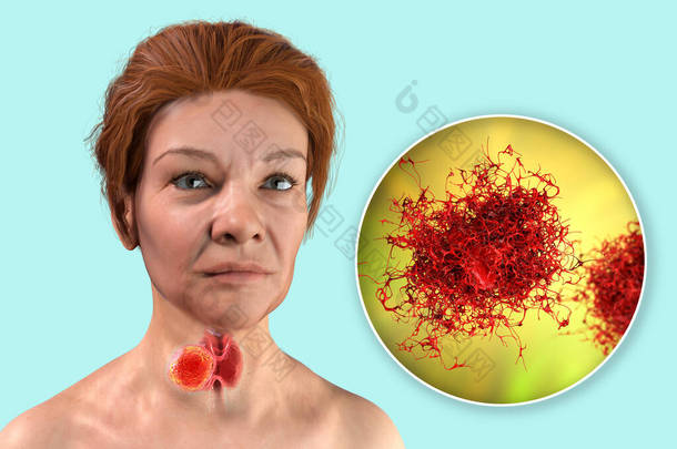 甲状腺癌Thyroid cancer.三维图像显示人体内有肿瘤的甲状腺和甲状腺癌细胞的特写