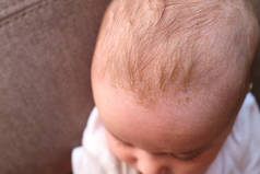 婴儿头上的摇篮帽(类风湿性皮炎)