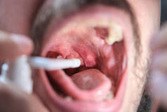 Man using a spray to treat an aphthae or sore on his throat.