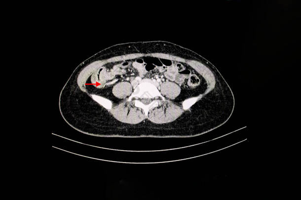 腹痛患者腹部CT扫描显示阑尾肿胀提示急性阑尾炎的诊断.