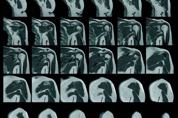 左肩袖撕裂与左肩部疑似脂肪瘤的磁共振成像及教育背景，医学.