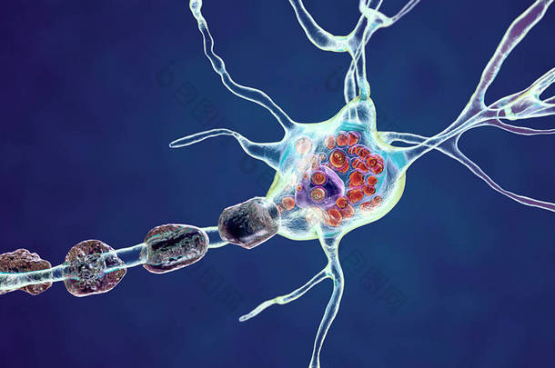 溶酶体储存性疾病、 Tay-Sachs 、 Niemann-Pick 、 Fabry等的脑<strong>神</strong>经。三维图解显示溶酶体中由于<strong>神</strong>经<strong>节</strong>苷的堆积而导致的带层状夹杂物的肿胀<strong>神</strong>经元