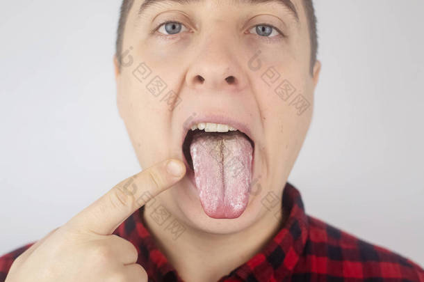 舌头上有白色的凝块.医生或胃肠学家检查人的舌头.病人的口腔卫生很差或有疾病症状。潜在疾病的症状.