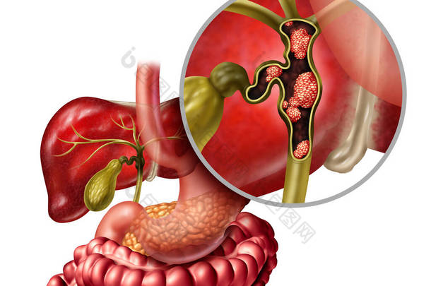 胆囊和肝脏为<strong>消化系统</strong>疾病的胆管癌或胆管癌，是<strong>人体</strong>器官解剖学中的一种医疗保健概念，带有三维图解.