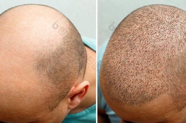 头发移植手术前后秃头男人的头。一个男人掉了头发就变得毛茸茸的.头发移植诊所的广告海报。秃头的治疗.