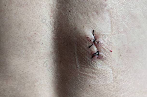 手术后用黑色医用线在人的皮肤上缝合线。皮肤上的术后缝合线用碘治疗。手术后皮肤干瘪