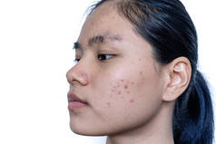 年轻的亚洲女人在面部皮肤出现问题时，会担心自己的脸。女性皮肤上的粉刺和疤痕问题。皮肤护理和健康概念问题.