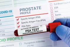 用于PSA前列腺特异性抗原检测的血管检查及申请表格.实验室PSA前列腺特异性抗原图谱检测的血样分析