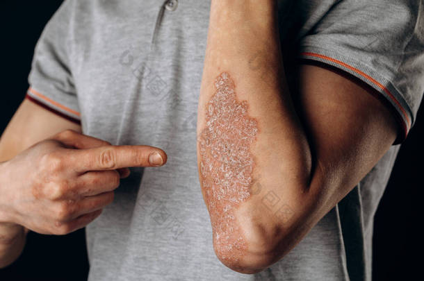 手肘上的急性银屑病是一种自身免疫力无法治愈的皮肤病.肘部红肿的、发炎的、片状的大皮疹受银屑病关节炎影响的关节.