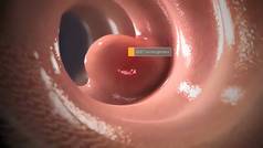胃肠道间质瘤是一种罕见的胃癌.3D插图