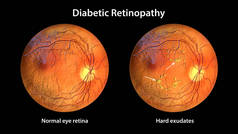 非增生性糖尿病视网膜病变3D图像显示正常眼视网膜和视网膜有硬渗出物(不规则形状的黄斑))