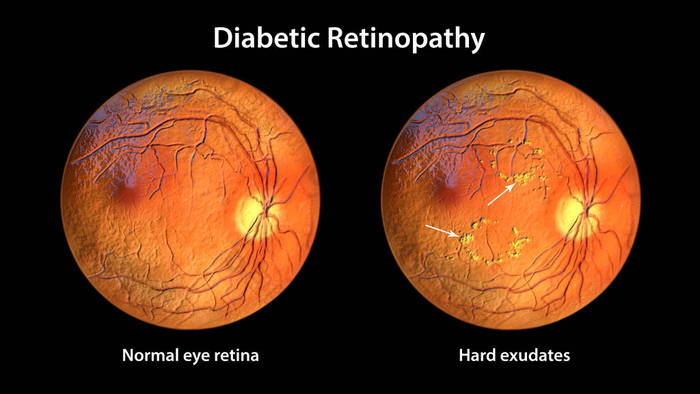 非增生性糖尿病视网膜病变3D图像显示正常眼视网膜和视网膜有硬渗出物(不规则形状的黄斑))