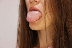女人的舌头肿得很大.曲奇水肿或胃食管反流病的过敏反应