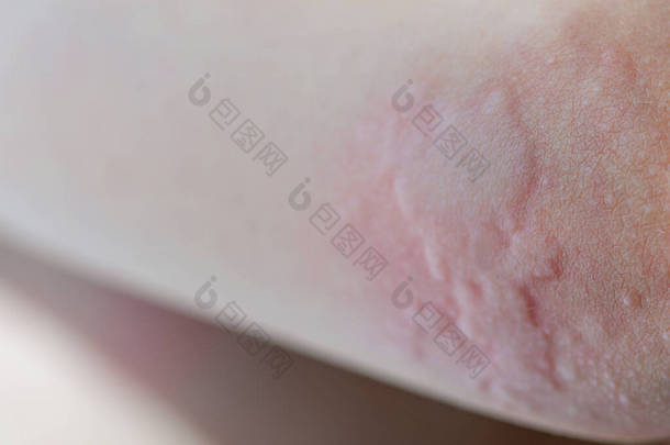 皮肤上有<strong>荨麻</strong>疹儿童皮肤上有过敏反应的红斑。<strong>荨麻</strong>疹症状闭锁.