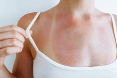 有泳衣痕迹的皮肤晒伤。女人皮肤疼痛、红肿、水泡、血管爆裂、晒伤的影响.