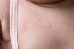 Pattern of Atopic eczema and fungal diseases on the human body.