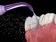 灌溉器，水牙清洁。口腔卫生的医学上准确的三维插图.