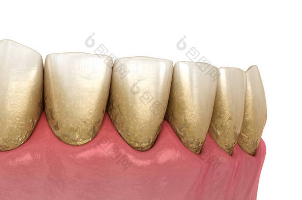 焦油和杆菌牙菌斑，<strong>下颌骨</strong>。医学上准确的人类牙齿治疗三维图像