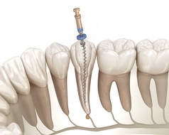 牙内根管治疗过程.医学上准确的牙齿3D图像.