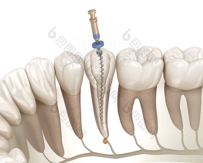 牙内根管治疗过程.医学上准确的牙齿3D图像.