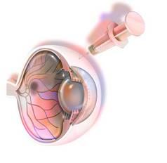 Treatment of macular degeneration by injection of RNA interference.