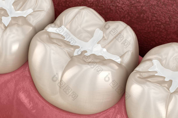 磨牙缝隙充填，医学上准确的牙科概念三维图解