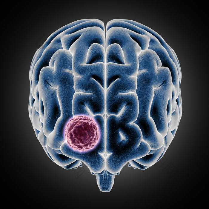 3d医疗大脑与肿瘤图像