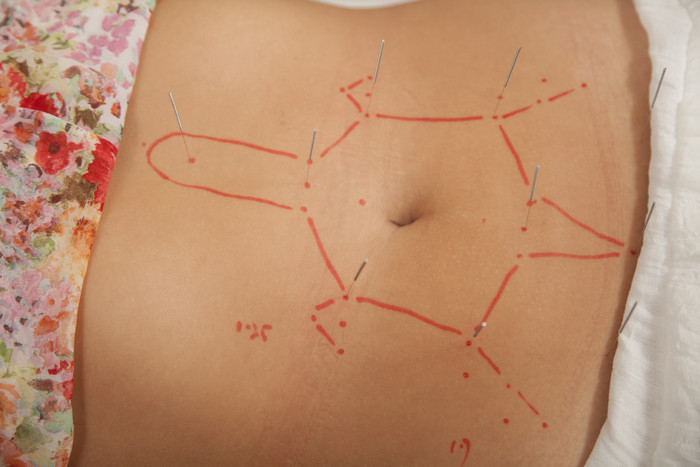 女性肚子针灸针标记计算医学医疗摄影图
