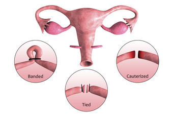 人体子宫输卵管插图解说