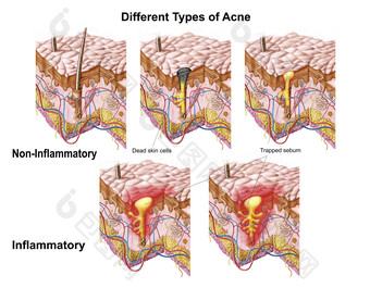 不同类型的痤疮摄影图