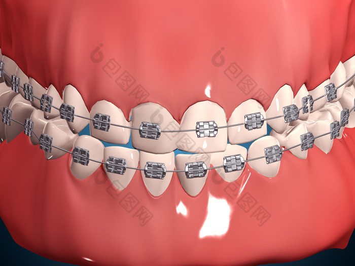 人类牙齿牙箍摄影图
