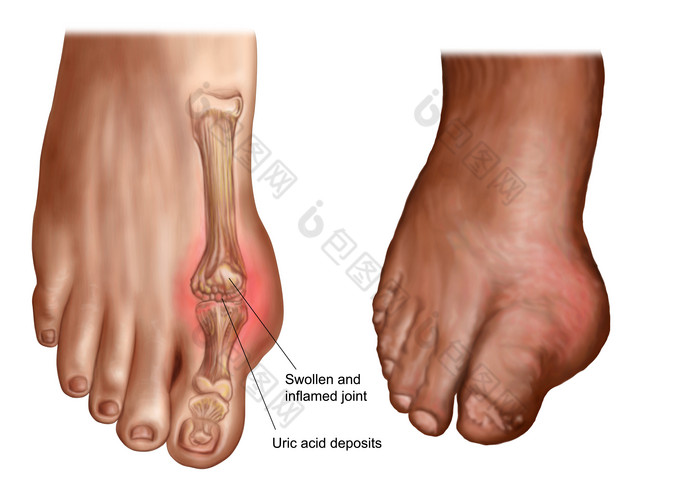 人体大脚趾关节疼痛示例图