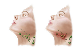 人体淋巴结发炎示例图