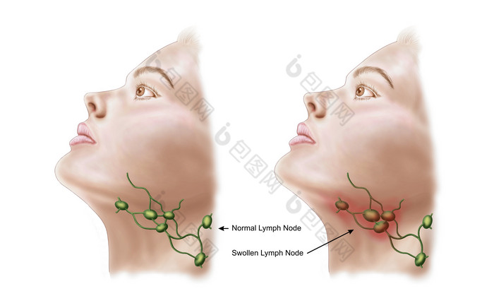人体淋巴炎症示例图