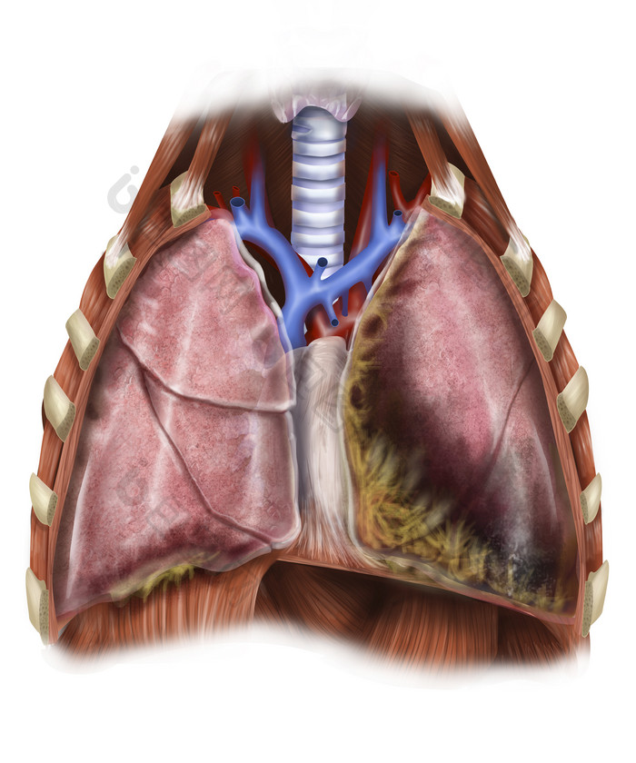 肺部肿瘤示例插图