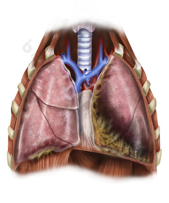 肺部<strong>肿瘤</strong>示例插图