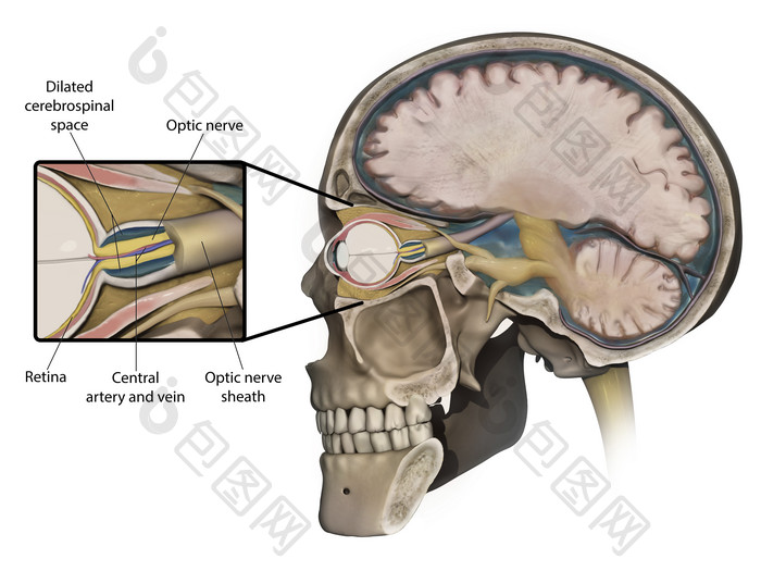 颅内视神经解剖示例插图