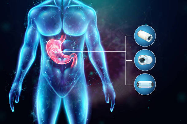 人体胃发炎的全息图和微型照相机、内窥镜术、消化道和胃病的概念。3D渲染，3D插图