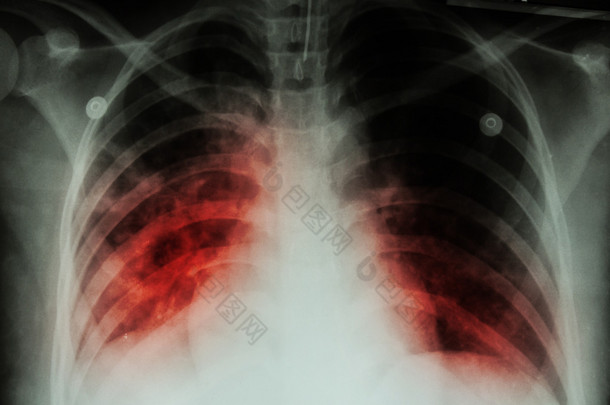 肺结核 (Tb): <strong>胸部</strong> x 光显示肺泡浸润在结核分枝杆菌肺结核 infectionpulmonary 结核 (Tb) 由于两肺: <strong>胸部</strong> x 光显示肺泡 infiltratio