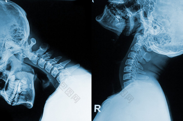 x 射线图像的<strong>脖子</strong>在 flex 和外延的位置显示颈部疼痛