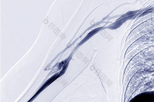 右臂的血管成形术、气球血管成形术和经皮腔内血管成形术(Pta).