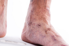 People with varicose veins of the lower extremities and venous t