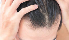 年轻男子头发损失概念严重脱发的问题