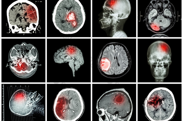 脑病收集（Ct扫描和脑Mri：显示脑梗死，脑内出血，脑肿瘤，基底神经<strong>结节</strong>出血（颅内切除术后状态） （保健概念） )