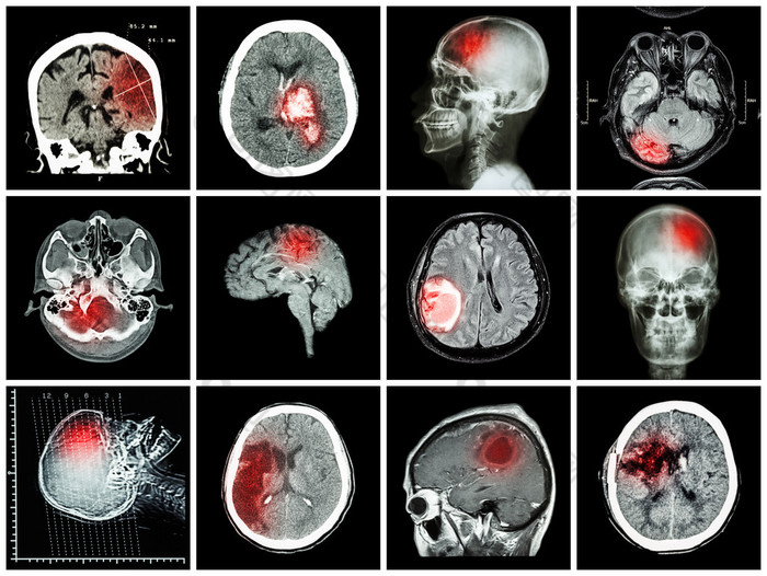 脑病收集（Ct扫描和脑Mri：显示脑梗死，脑内出血，脑肿瘤，基底神经结节出血（颅内切除术后状态） （保健概念） )