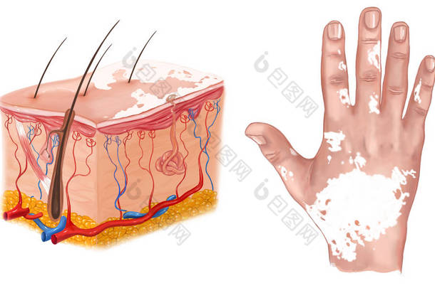 医学插图的<strong>白</strong>癜风的疗效