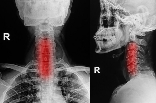  颈椎、 颈部 x 射线图像的 x 射线图像