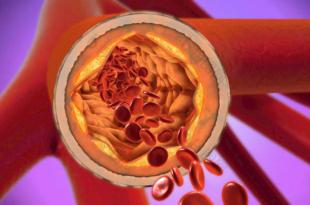 3d. 一个沉淀和收缩血管的图示或