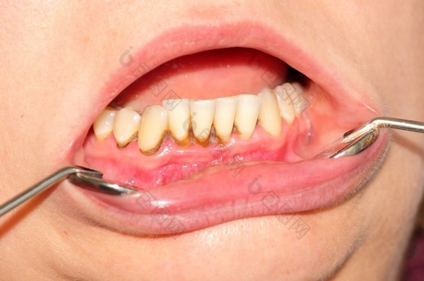 牙垢和牙菌斑